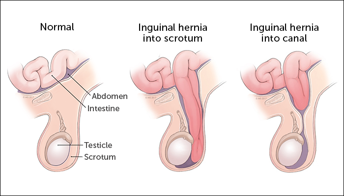 Illustration of an inguinal hernia into scrotum and inguinal hernia into canal.
