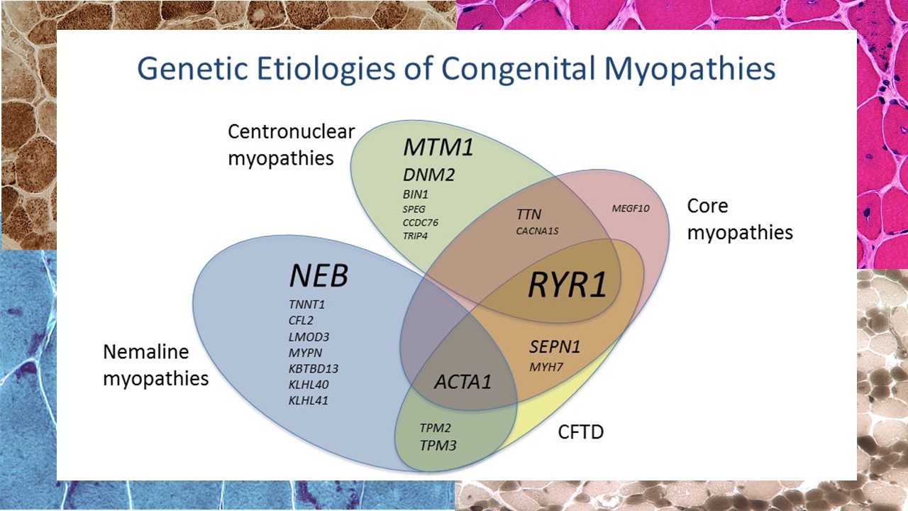 The genetic etiologies of congenital myopathies.
