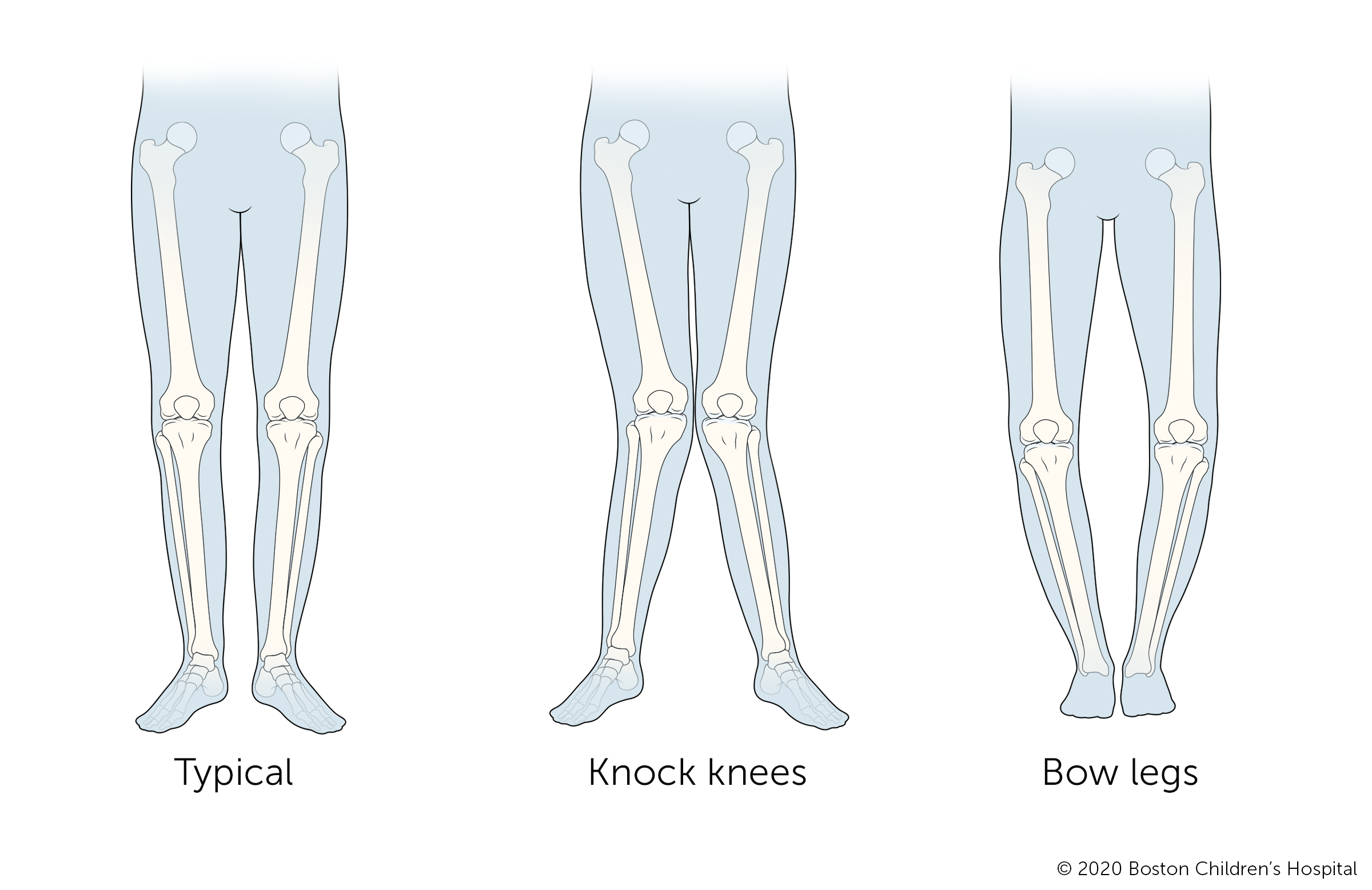 An illustration of typical legs, legs with knock knees, and legs with bowlegs.