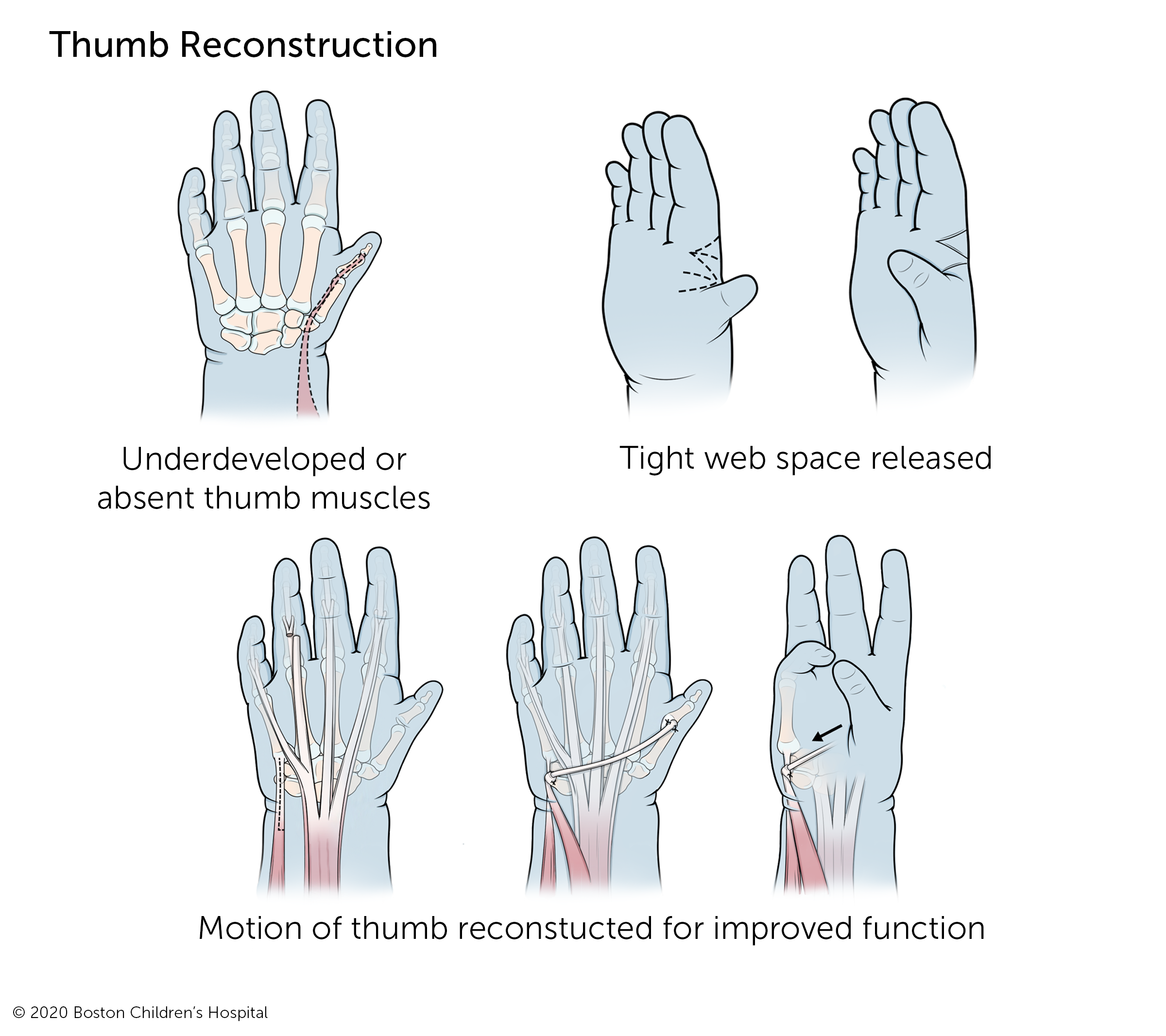 For thumb reconstruction, underdeveloped or absent thumb muscles are reconstructed and the tight skin between the thumb and forefinger are released for improved thumb function.