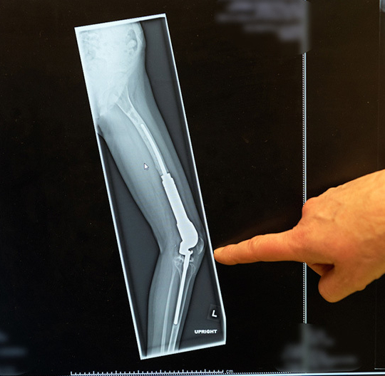 person pointing to xray of leg bones