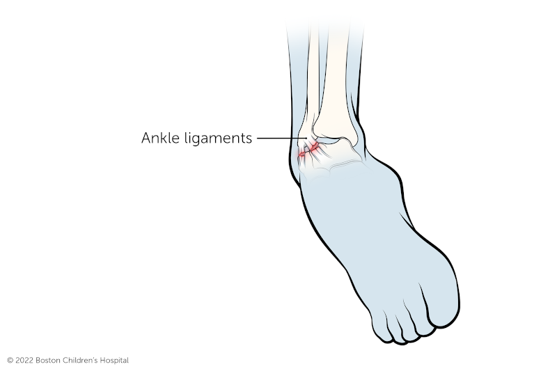 Leg day online with sprained ankle