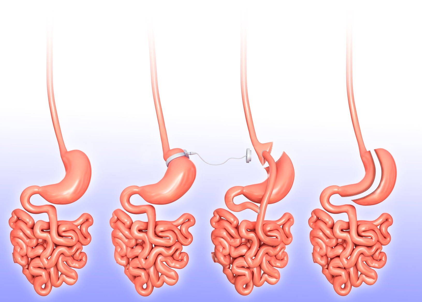 Four panels of the small intestine that show weight loss with bariatric surgery.