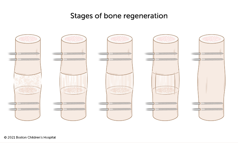Stages of bone regeneration: Over time, the gap between the two ends of the bone fills in with new bone, eventually forming solid bone.