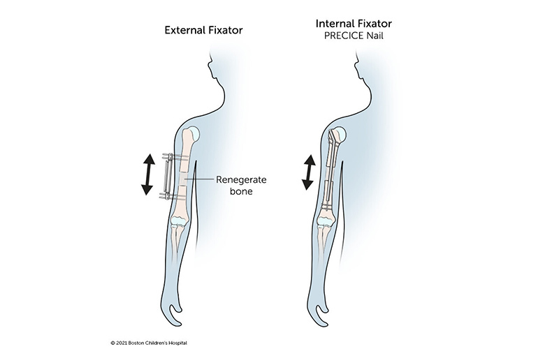 Two arm-lengthening devices: An external fixator is a rod attached to the outside of the upper arm with screws. The internal fixator (PRECICE Nail) is implanted inside the bone and extends from the shoulder almost to the elbow.