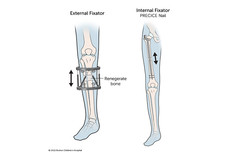 Two leg-lengthening devices: An external fixator circles the leg and is attached to the two ends of the bone with screws. The internal fixator (PRECICE Nail) is implanted inside the bone and extends from the top of the thigh bone almost to the top of the knee.