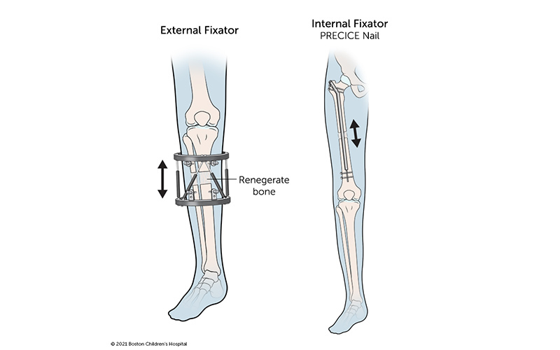 https://www.childrenshospital.org/sites/default/files/2022-07/limb-lengthening-leg-devices.jpg