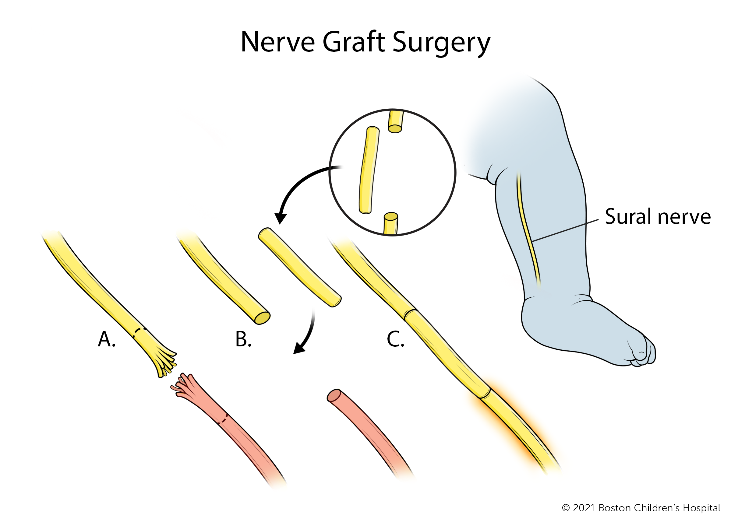 During nerve graft surgery, the injured portion of the brachial plexus nerve is removed and replaces with a section of sural nerve from the leg.
