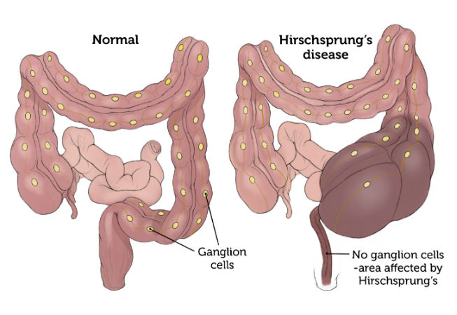 Ziekte van Hirschsprung op latere leeftijd: diagnose en behandeling