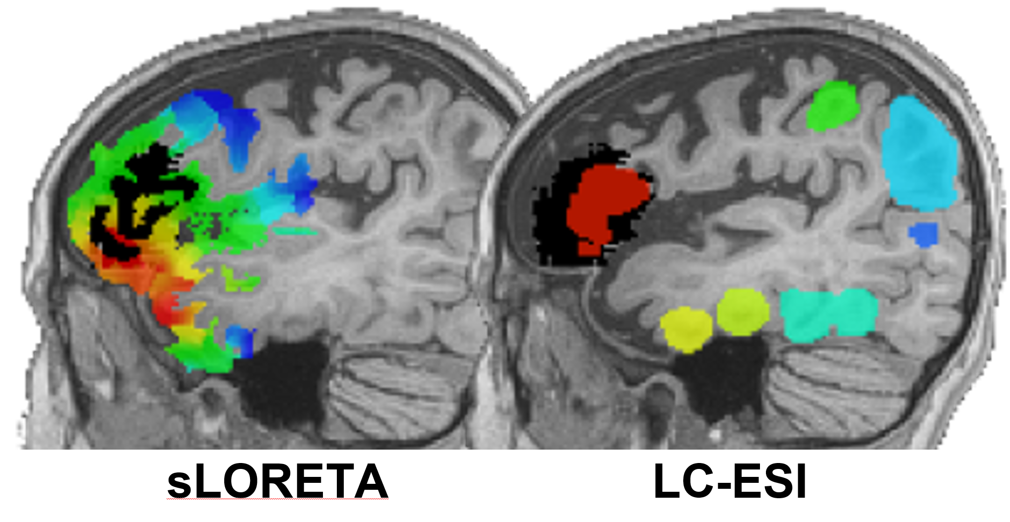 Two scans of brains with the first image highlighting sLORETA and the second image highlighting LC-ESI.