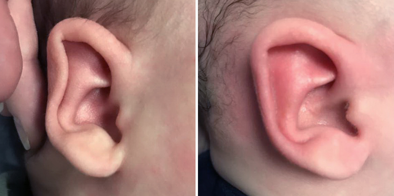 Ear molding: Before (left) and after images