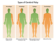 4 anatomical bodies illustrating four types of cerebral palsy