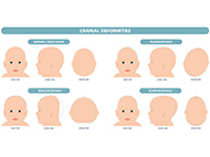 four illustrations of craniofacial anomalies 