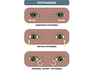 digram showing horizontal, vertical, and torsional nystagmus