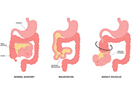 diagram if three gi tracts showing normal anatomy, malrotation and midgut volvulus 