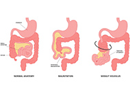 diagram if three gi tracts showing normal anatomy, malrotation and midgut volvulus