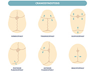 illustration of six types of skull craniosynostosis; nomocephaly, trigonocephaly, scaphocephaly, posterior plagiocephaly, anterior plagocephaly, and brachycephaly