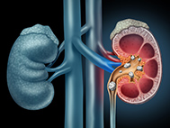 kidney with kidney stones