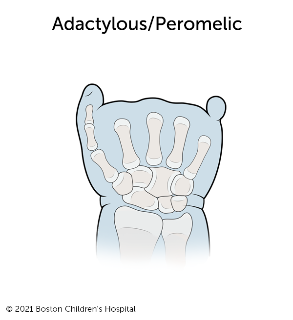 Illustration of adactylous/peromelic symbrachydactyly