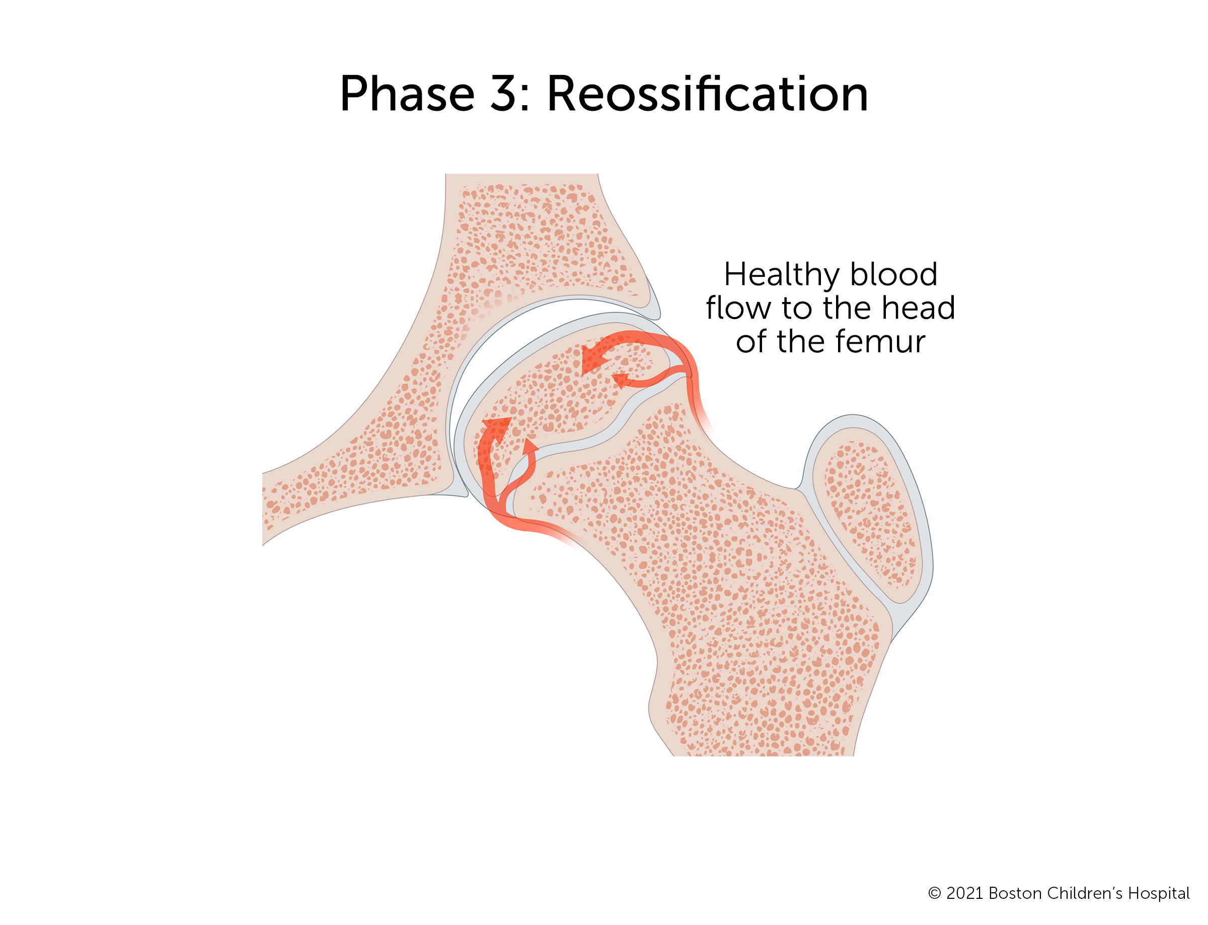 Phase 3: Reossification. Healthy blood flow returns to the head of the femur and new bone grows, making the gap in the socket smaller.