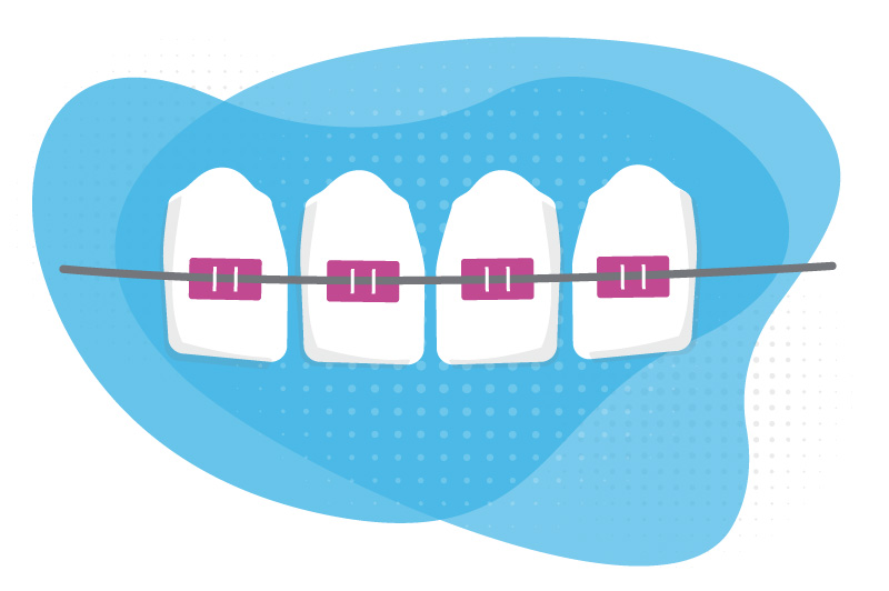 Illustration of teeth held together by wire, against a blue background.