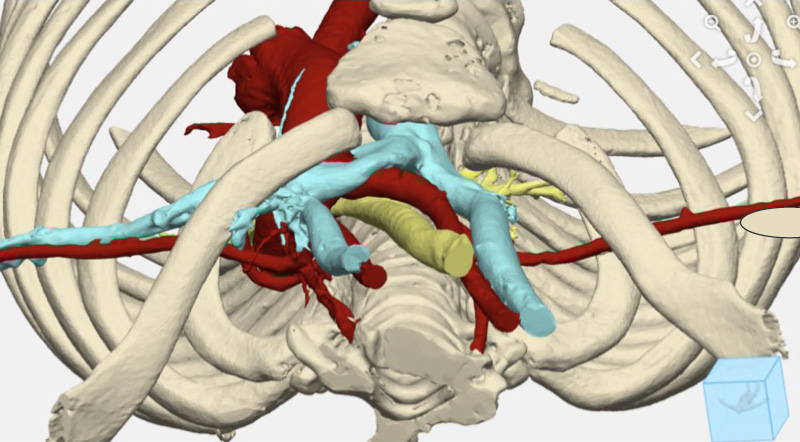 This 3D model of a young girl's chest anatomy looks down into the chest wall cavity to show compression between her airway, spine, aorta, and sternum.