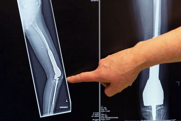 Boston Children's Bone and Soft Tissue Tumors Program