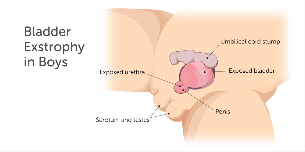 Illustration of bladder exstrophy in boys: exposed bladder, urethra, penis, scrotum, testes, umbilical stump.