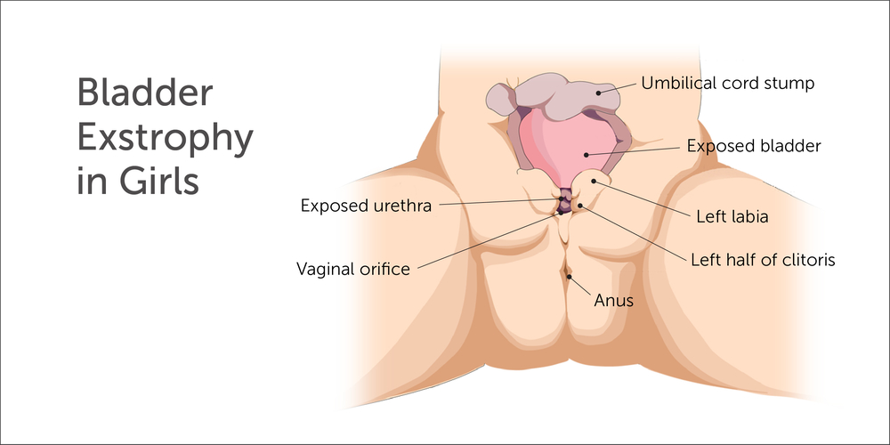 Illustration of bladder exstrophy in girls: exposed bladder, urethra, labia, clitoris, vagina, anus, umbilical stump.