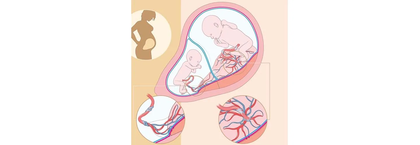 Two-toned yellow square with a graphic of a pregnant woman outline and of two fetuses in utero with two circles showing a close up of a velamentus umbilical cord insertion and normal umbilical cord insertion