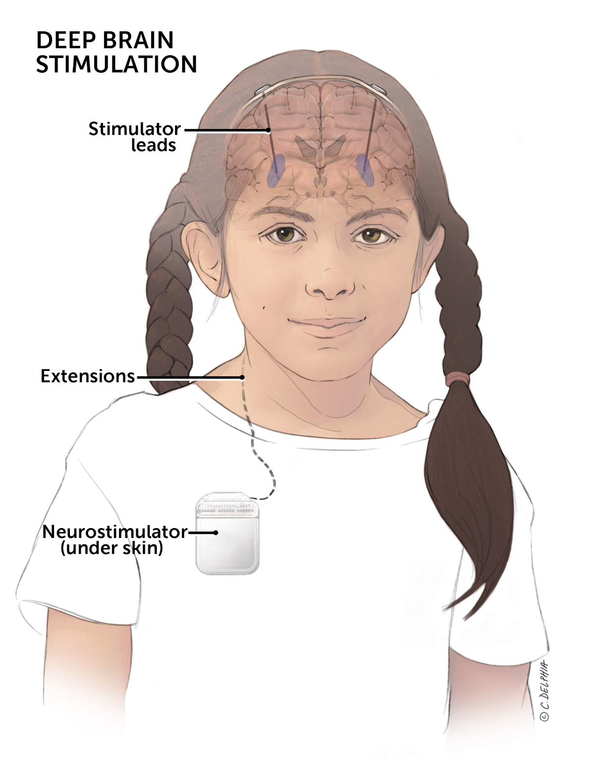 An image of a young girl with notes pointing at stimulator leads, extensions, and neurostimulator (under skin), along with text “DEEP BRAIN STIMULATION.”