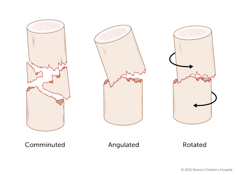 From left: A comminuted fracture, angulated fracture, and rotated fracture.