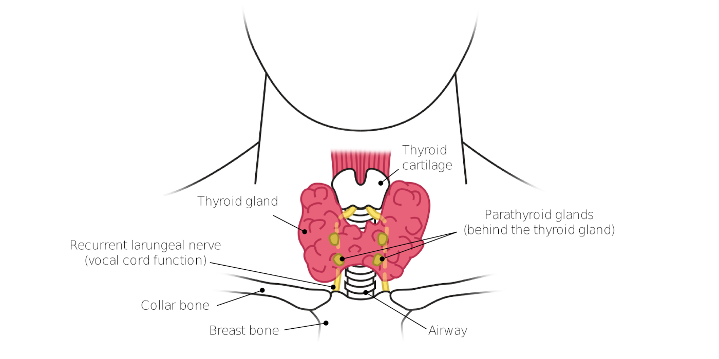 Diagram of the human neck showing the thyroid gland, parathyroid glands, thyroid cartilage, recurrent laryngeal nerve, collar bone, breast bone, and airway.
