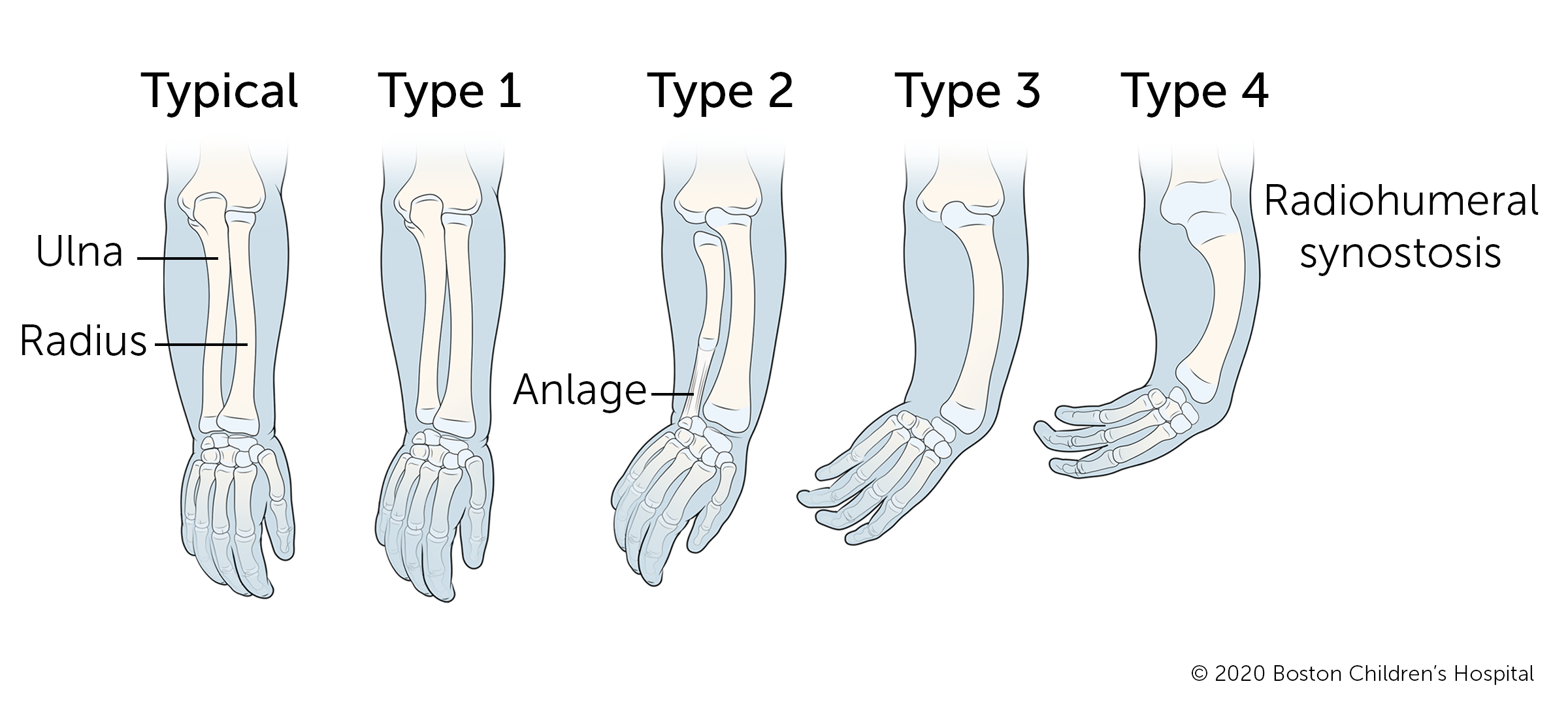 Diagram showing five forearms labeled as Typical, Type 1, Type 2, Type 3, and Type 4, illustrating increasing abnormalities in bone structure, including missing bones and fusion in Type 4.
