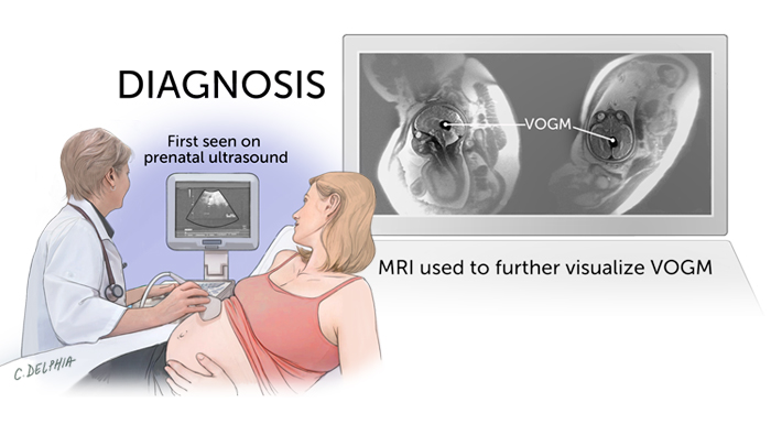 Educational graphic of prenatal diagnosis: a doctor performs an ultrasound on a pregnant person while a screen shows the fetus. Beside it, MRI scans identify a labeled VOGM (vein of Galen malformation), emphasizing follow-up imaging after initial ultrasound detection.
