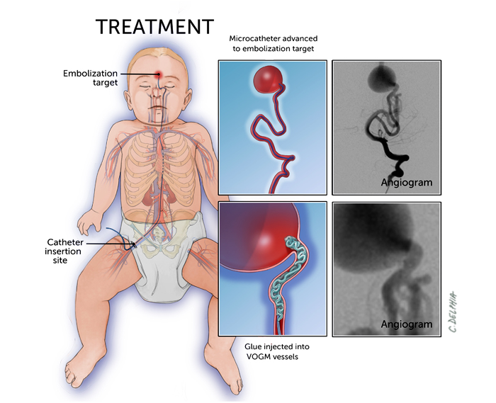 Illustration of an infant with labeled catheter path for treatment of vein of Galen malformation. Includes angiogram images showing blood vessel detail.