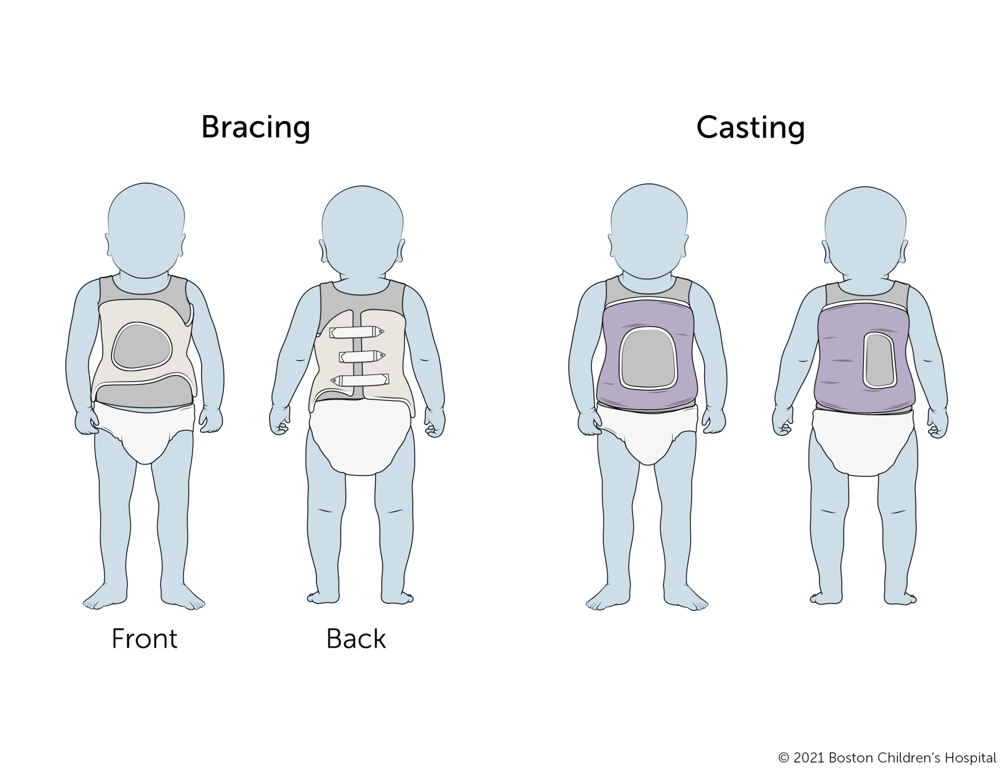 Braces for infantile scoliosis usually have a keyhole opening in the front and straps in the back. Casts for infantile scoliosis go all the way around the torso with keyhole openings in the front and back.