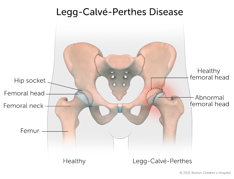 A healthy hip compared to a hip joint with Legg-Calve-Perthes disease. In the healthy hip, the femoral head is round and fits securely into the hip socket. In the hip with Perthes disease, the femoral head has flattened out, and there’s a pocket of empt