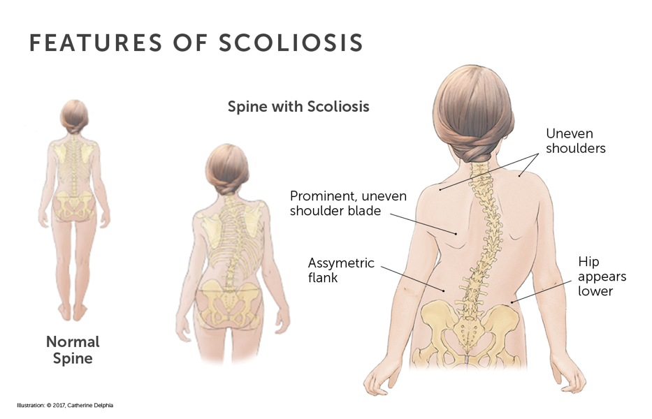 This is a look at the features of scoliosis