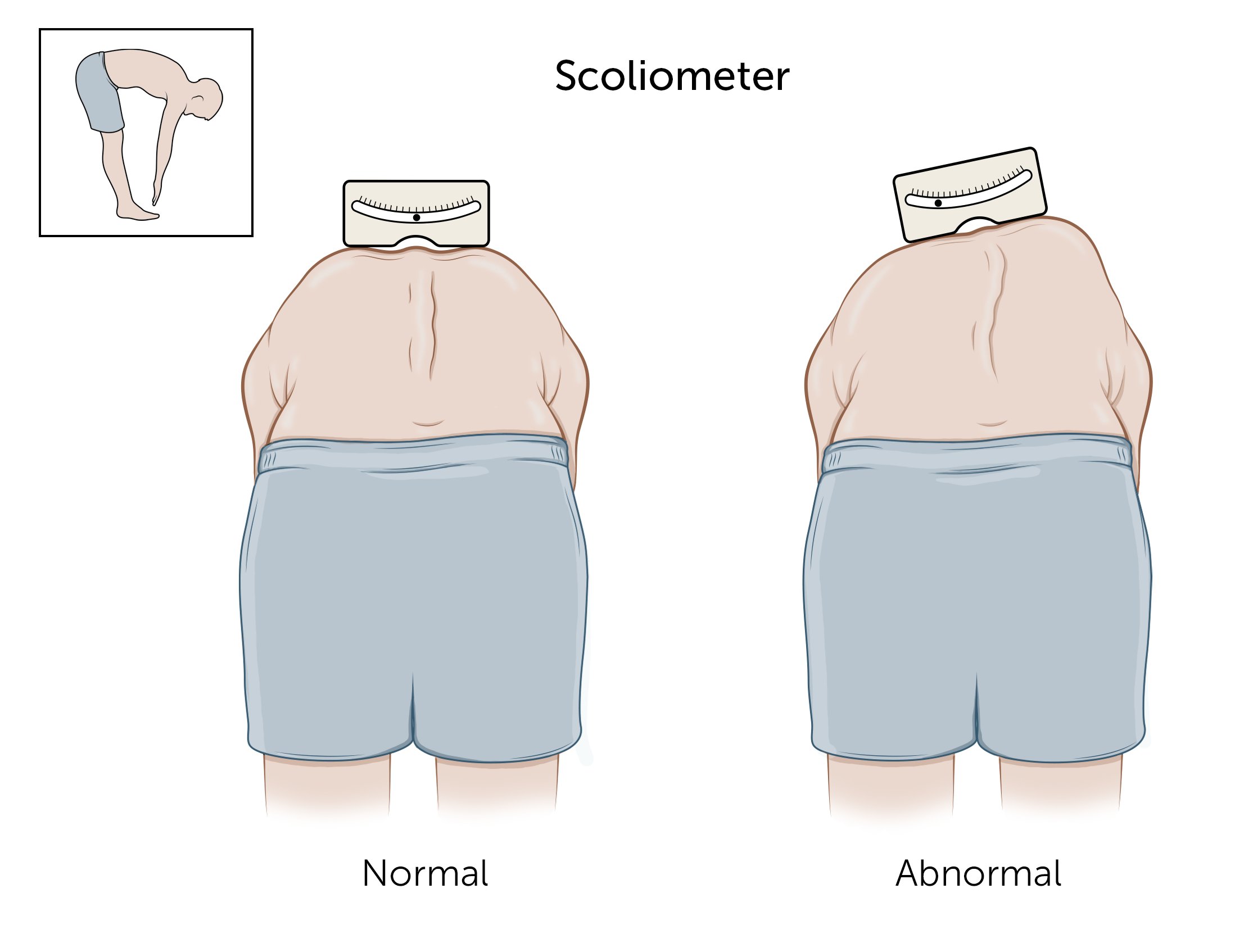 Scoliosis test with Scolimeter. Illustration of diagnosing scoliosis.