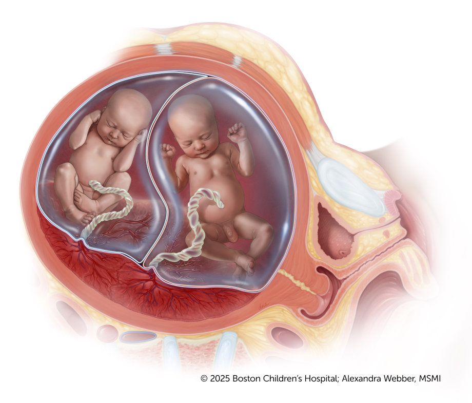 A medical illustration of twins in utero with a shared placenta, but each in a separate amniotic sac with their own umbilical cords.