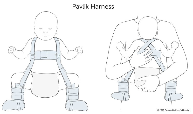 An image of a Pavlik harness
