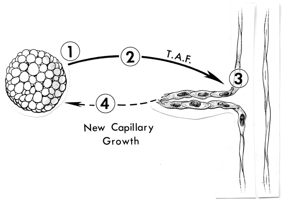 New capillary growth with four steps: at the site of tumor angiogenesis factor (TAF) synthesis, at the site of transmission of TAF through tissues, during endothelial cell mitoses, and as new vessels begin to penetrate the tumor.