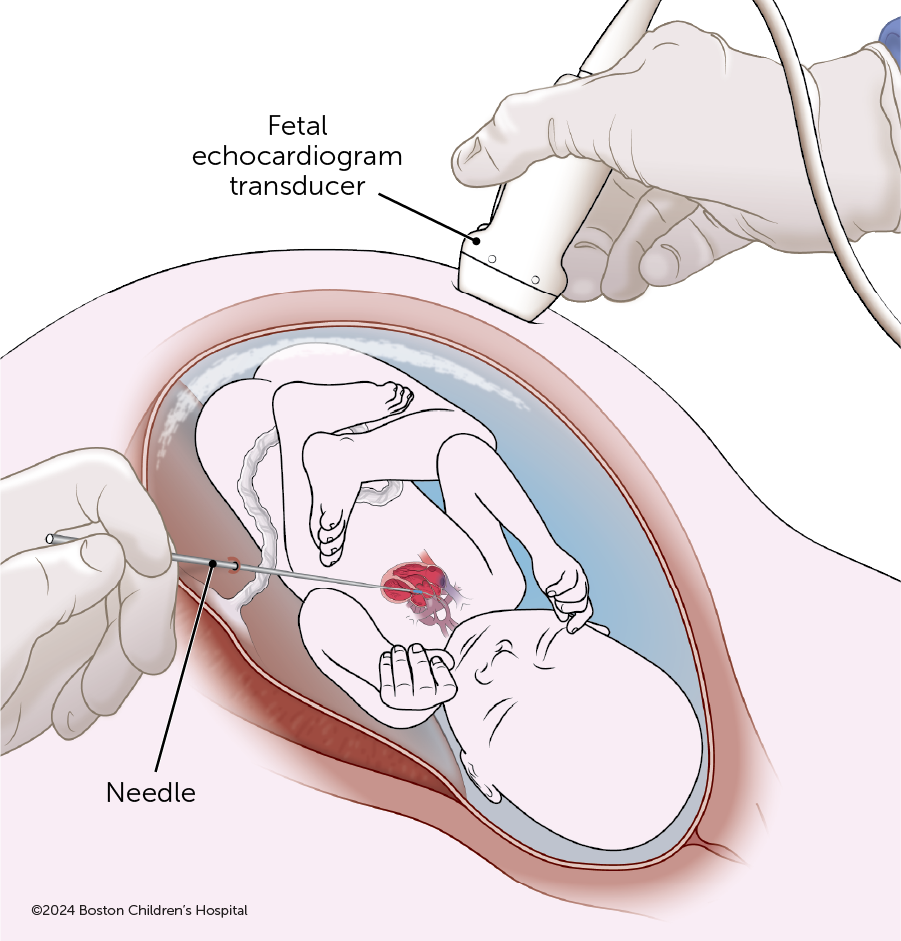 An illustration shows a fetus in the womb during cardiac intervention. A needle and echocardiogram transducer guide the procedure.