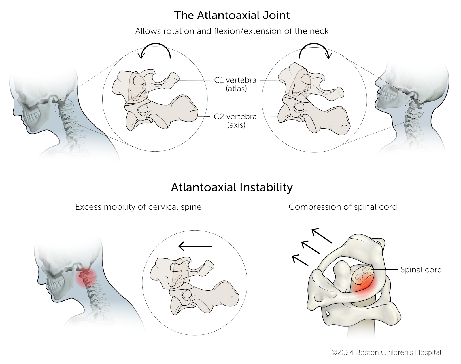 Atlantoaxial Instability Treatment Atlantoaxial Instability Treatment