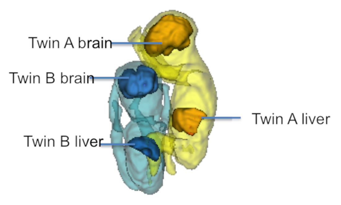 MRI image showing a pair of twins in utero with callouts to the brain and liver (Twin A brain and liver, Twin B brain and liver)