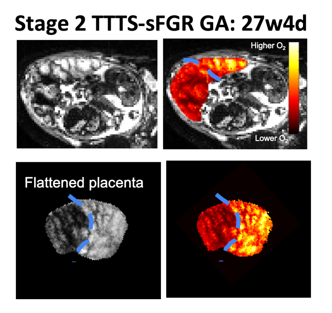 MRI image showing a placenta, placental measurements, a flattened placenta and a placenta diagnosed with Stage 2 TTTS and sFGR (GA at MRI: 27w4d).