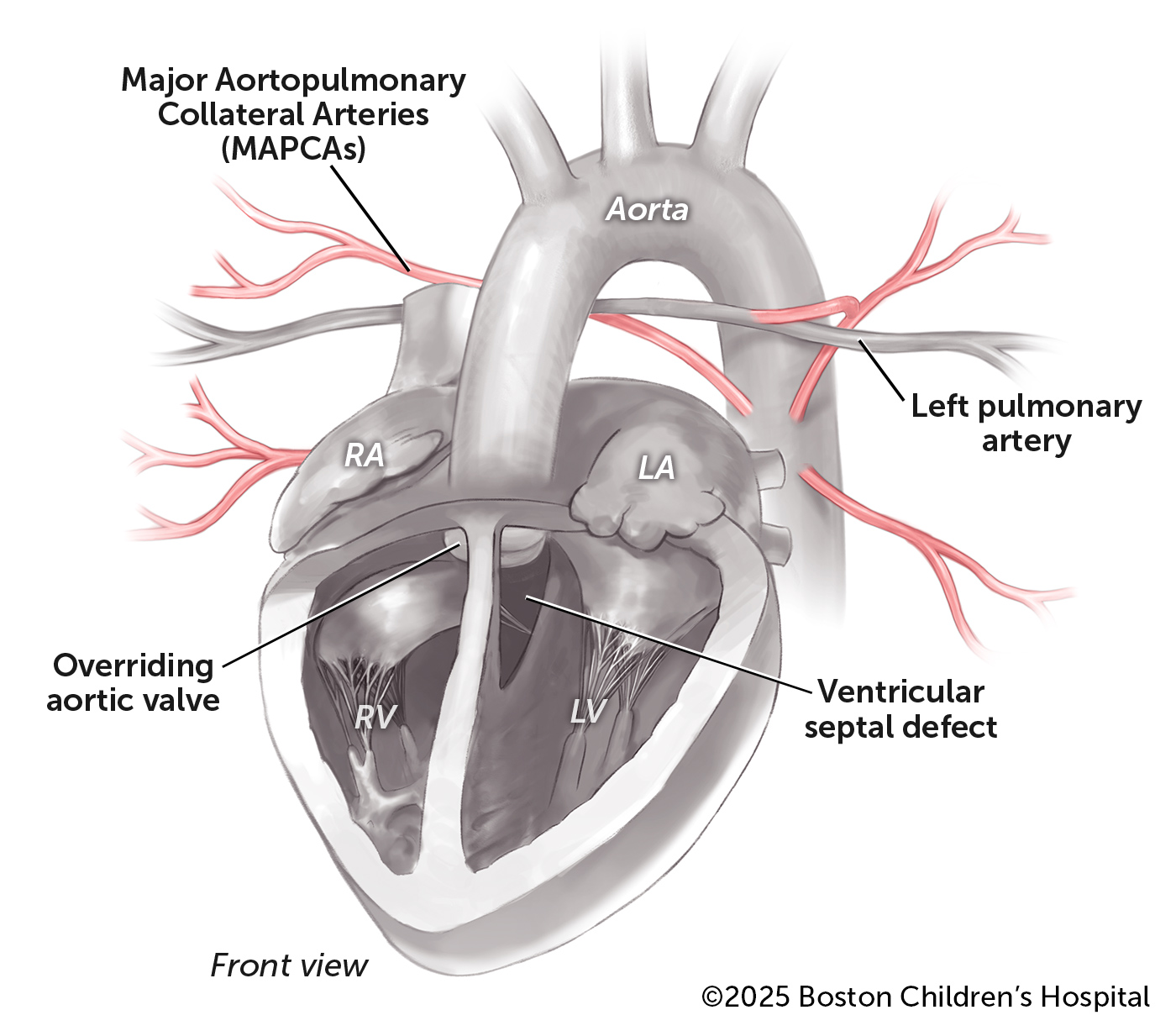 A medical illustration of a heart with tetralogy of Fallot (ToF) with pulmonary atresia and major aortopulmonary collateral arteries (MAPCAs) before surgery.