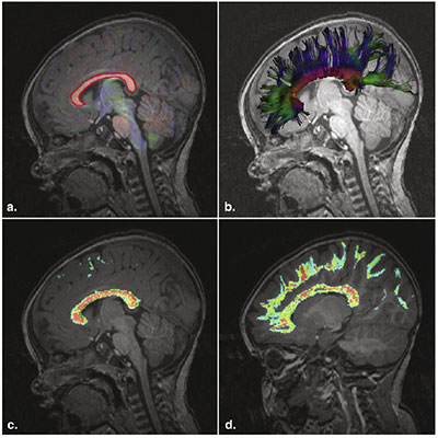 Density Weighted Statistics (DWS) in Diffusion Tensor Imaging (DTI) tractography