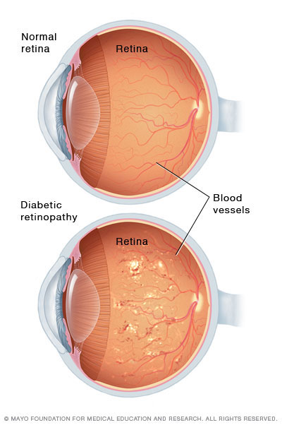 Diabetic Retinopathy Diagram